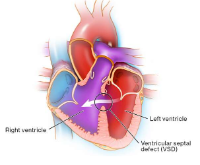 Business Listing Best Hospitals for Ventricular Septal Defect India in Chennai TN